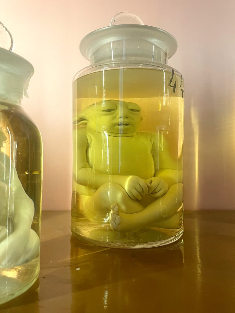Dans le formol du Musée d'anatomie de Naples.