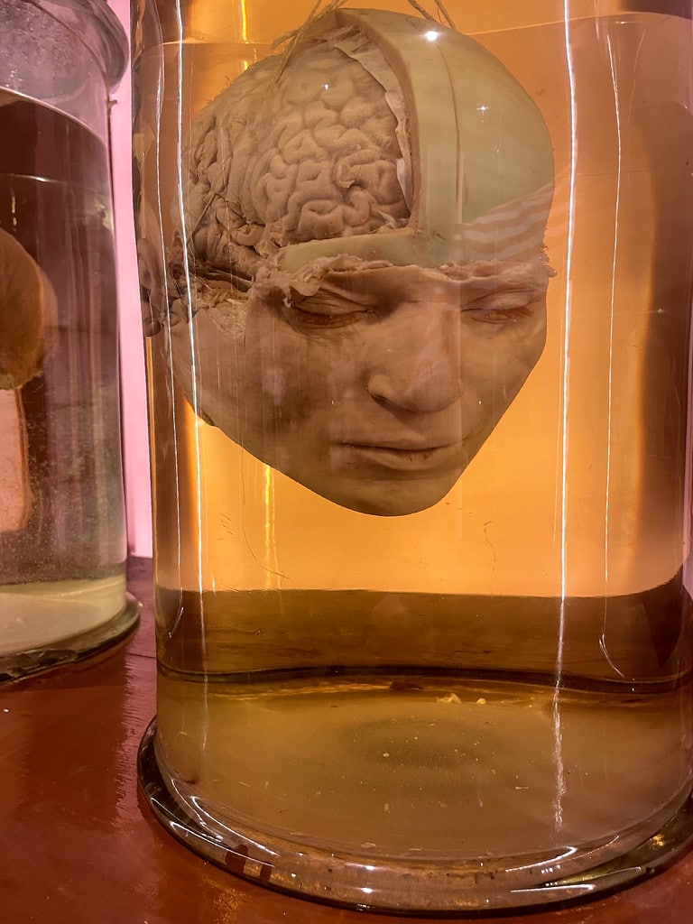 Dans le formol du Musée d'anatomie de Naples.